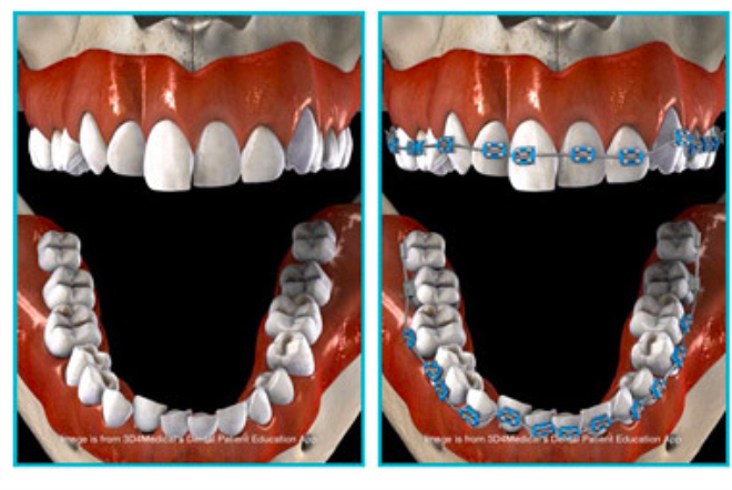 Ortodonti Tedavisinin Bizlere Sunduğu Avantajlar